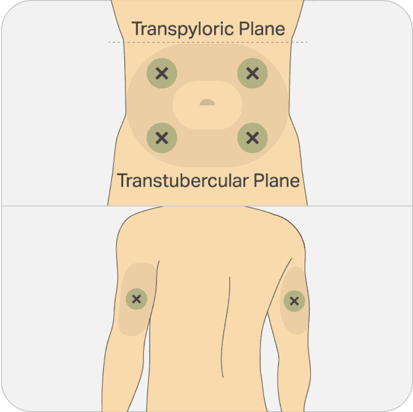 Top image showing potential injection sites on the abdomen approximately 2 inches away from the navel. Bottom image showing potential injection sites on the back of the upper arm.